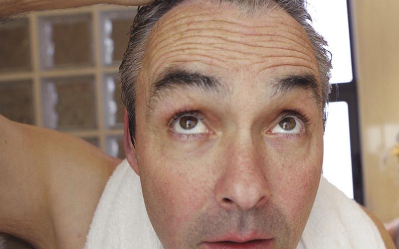 Hair loss men