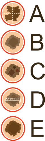 skin cancer graphic